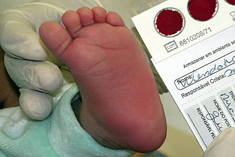 Diagnóstico da Doença Falciforme é feito pelo exame de triagem neonatal, também conhecido como Teste do Pezinho