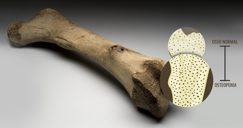 Representação de um osso que sofre de osteopenia. Em destaque é demonstrada a perda de massa óssea, em comparação com um osso normal. Fotomontagem sobre imagens Wikimedia Commons
