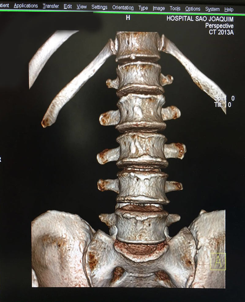 Tomografia em 3D mostra em detalhes uma coluna analisada
