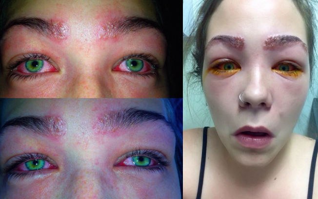 Reação alérgica causou queimaduras nas sobrancelhas e fez com que lágrimas e pus escorressem dos olhos da jovem (Foto: Facebook/ Tylah Jae Durie/ Reprodução)