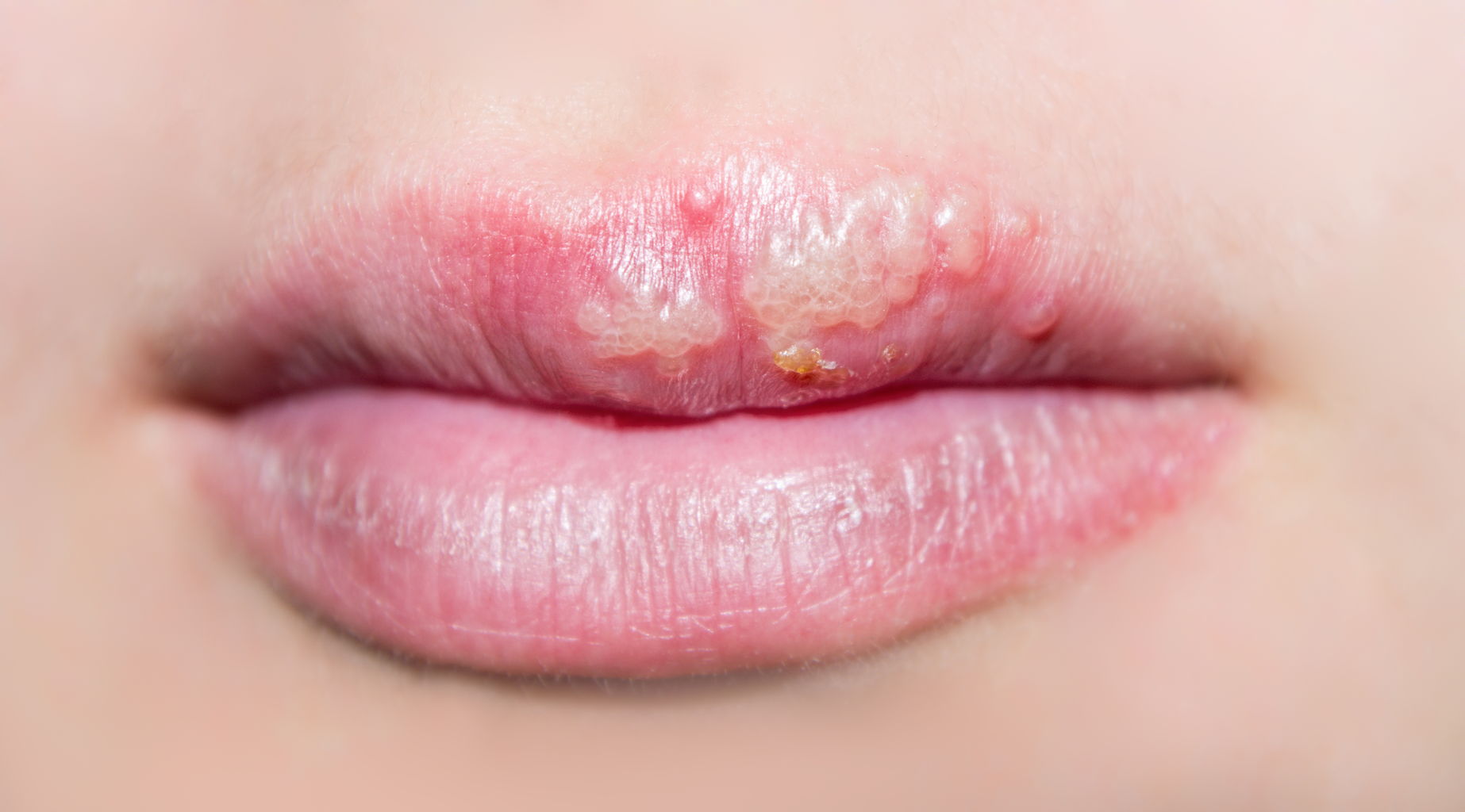 A herpes labial é um dos problemas mais comuns nesta época do ano