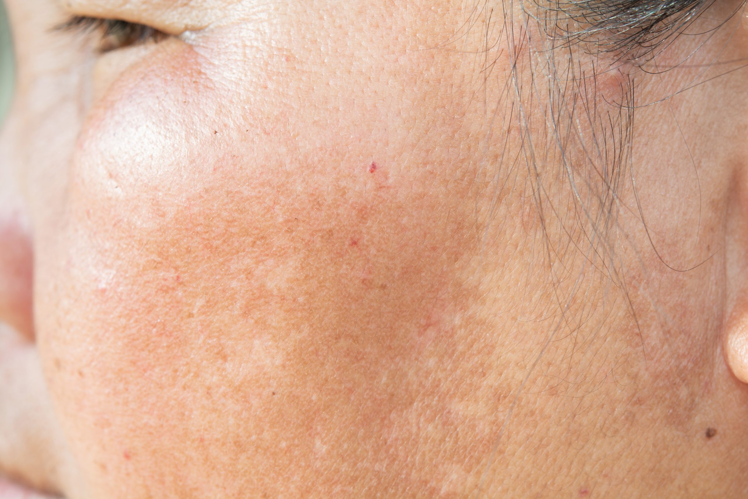 melasma