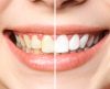 Clareamento dental: veja mitos e verdades sobre o procedimento antes de fazer - Jornal da Franca