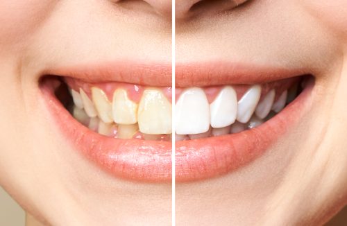 Clareamento dental: veja mitos e verdades sobre o procedimento antes de fazer - Jornal da Franca