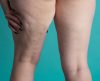 Lipedema: conheça tratamentos estéticos para controlar condição - Jornal da Franca