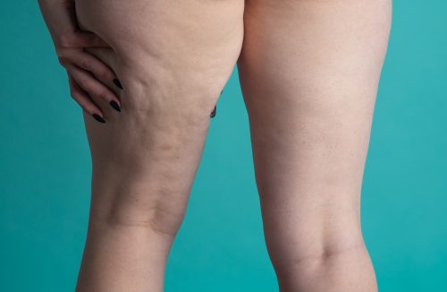 Lipedema: conheça tratamentos estéticos para controlar condição - Jornal da Franca