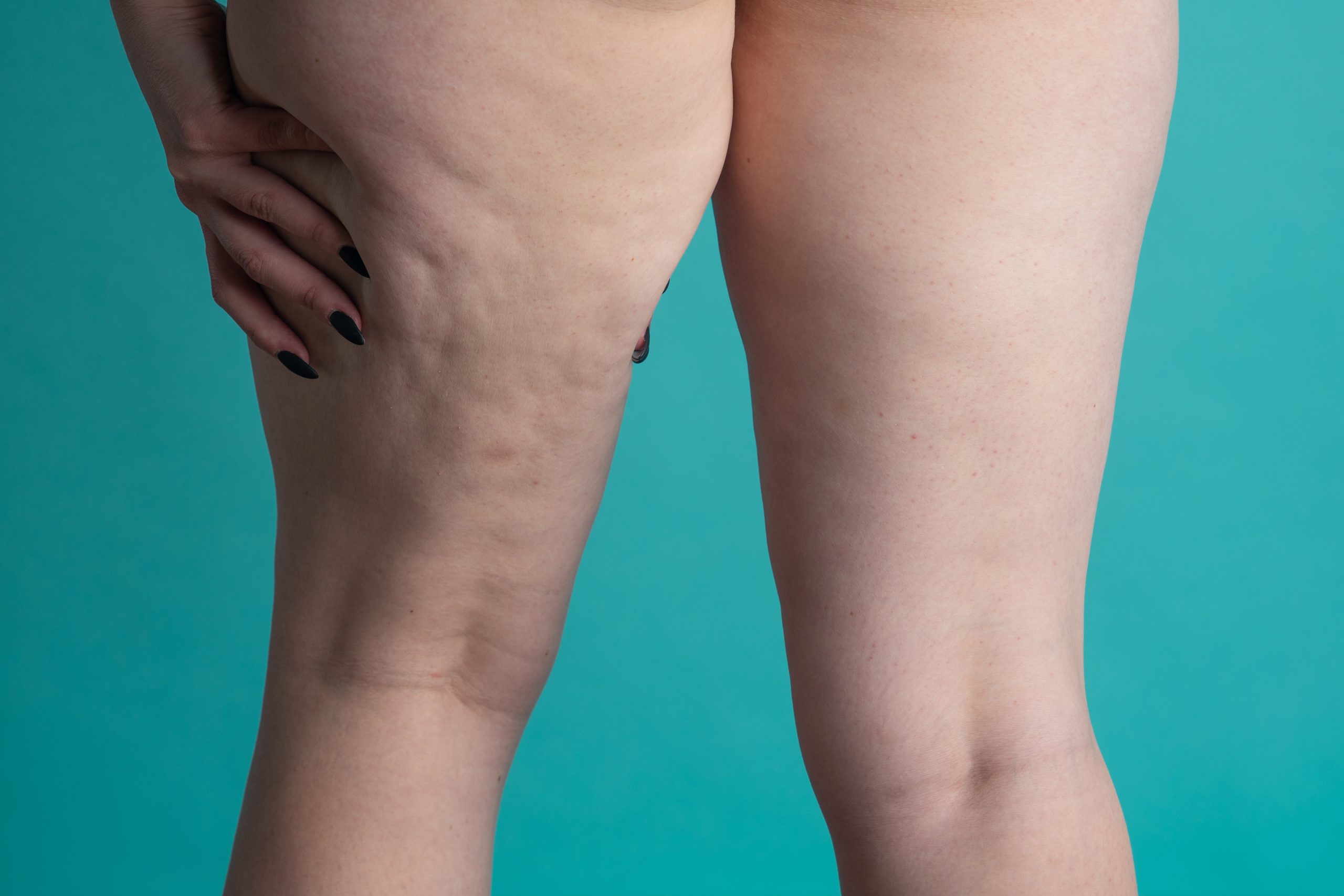 Como identificar e tratar lipedema, doença que causa acúmulo de gordura nas  pernas