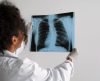 Mais de 6 mil brasileiros que nunca fumaram podem ter câncer de pulmão só neste ano - Jornal da Franca